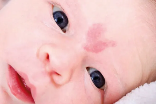 Dudak Damak Yarıkları - Prof. Dr. Hakan Ağır