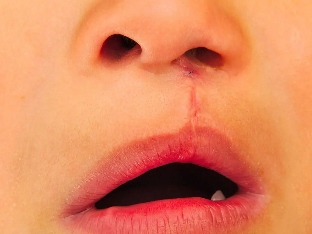 Dudak Damak Yarıkları - Prof. Dr. Hakan Ağır