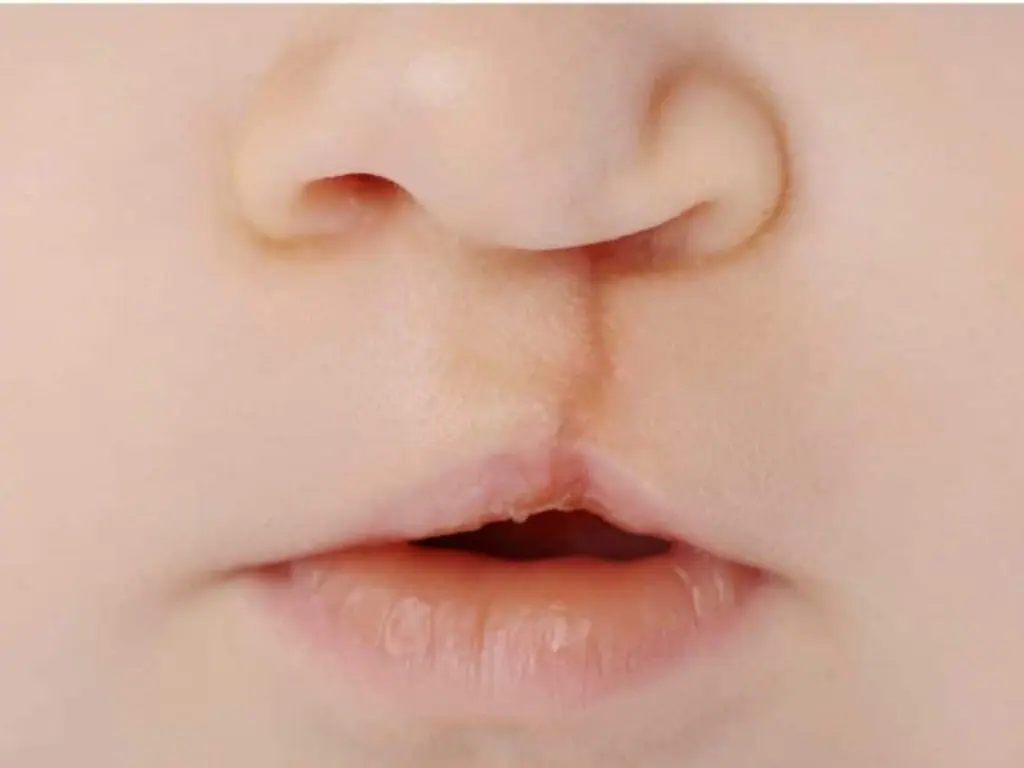 Dudak Damak Yarıkları - Prof. Dr. Hakan Ağır