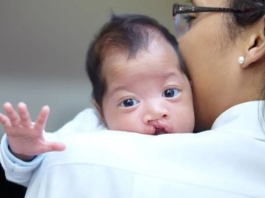 Dudak Damak Yarıkları - Prof. Dr. Hakan Ağır