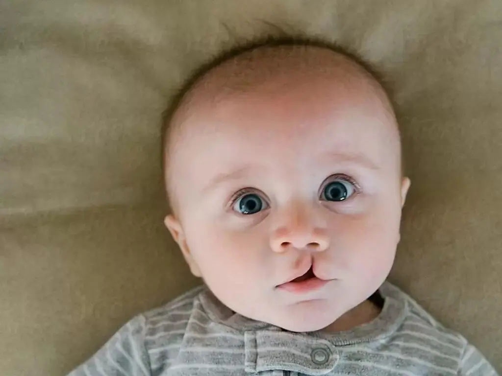 Dudak Damak Yarıkları - Prof. Dr. Hakan Ağır