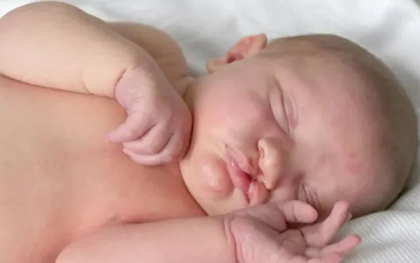 Dudak Damak Yarıkları - Prof. Dr. Hakan Ağır