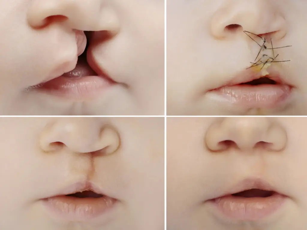 Dudak Damak Yarıkları - Prof. Dr. Hakan Ağır