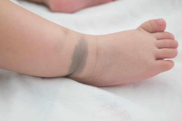 Bebeklerde ve Çocuklarda Görülen Doğum Lekeleri Nelerdir? Neden Olurlar
