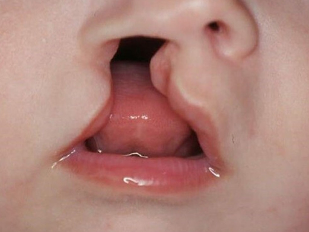 dudak damak yarıkları