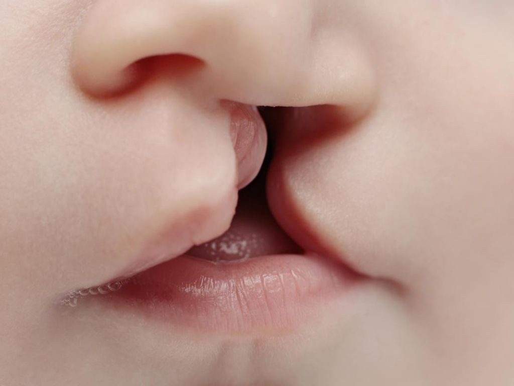 dudak damak yarıkları genetik midir konuşmaya engel midir